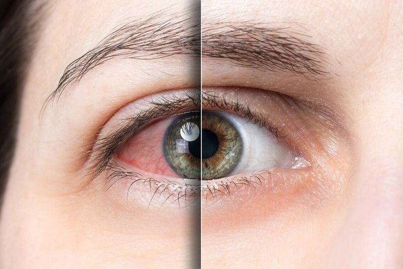 Bệnh khô mắt ở người già và cách phòng ngừa bệnh