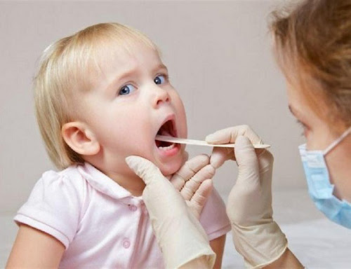 Bệnh viêm họng ở trẻ em và cách phòng bệnh cho trẻ