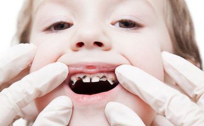 Tìm hiểu về bệnh sâu răng ở trẻ nhỏ và cách phòng ngừa